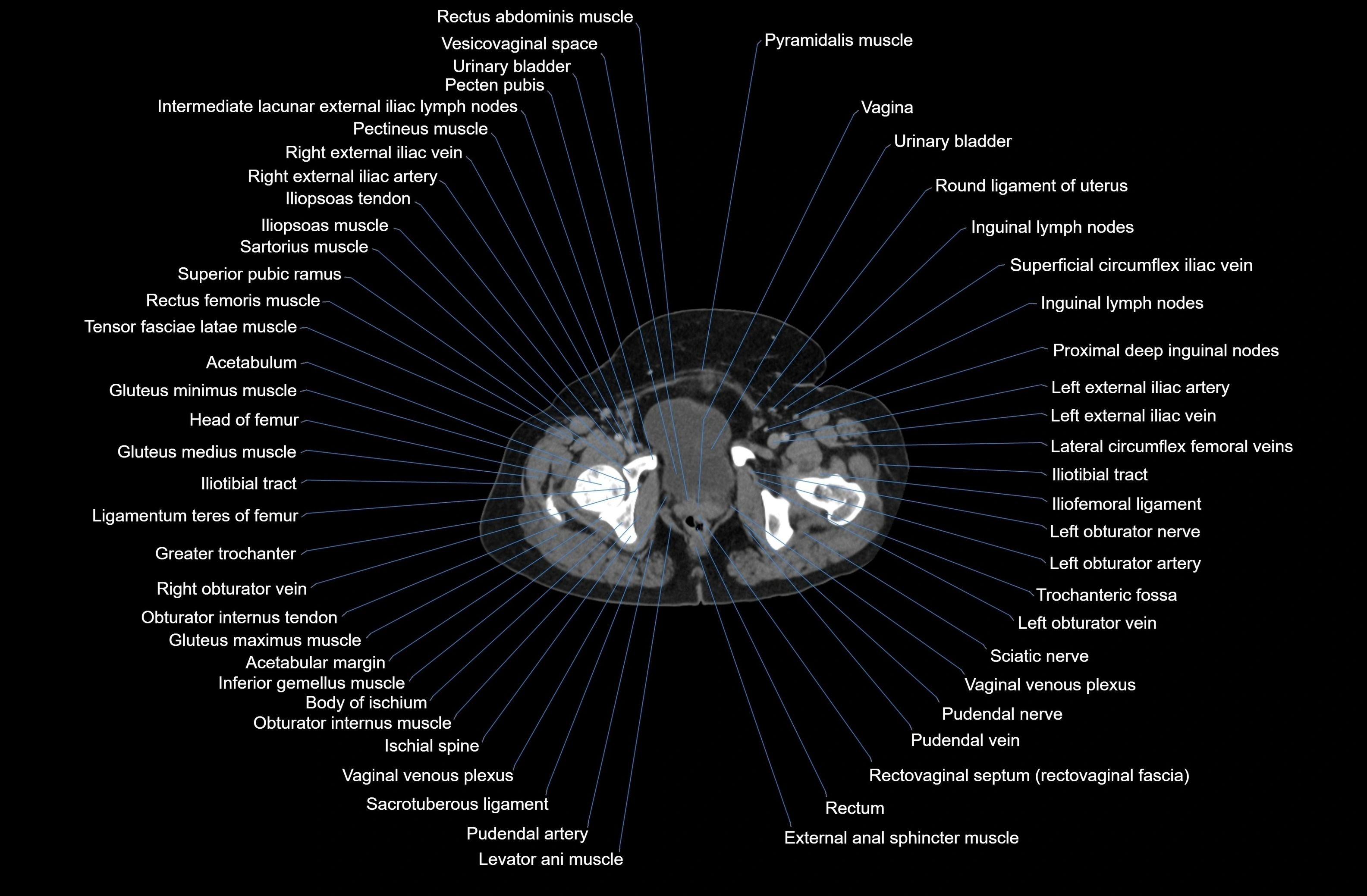 CT Abdomen axial cross sectional anatomy labelled radiology image-00095.webp